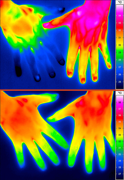 InfraTec ImageIR Thermal image of hands before and after regulation therapy.